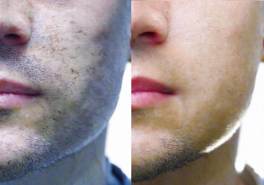 ヒゲ脱毛前後の変化:施術前の濃いヒゲと施術後のすっきりした肌