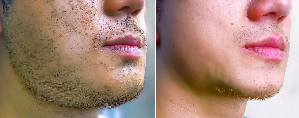 ヒゲ脱毛効果のビフォーアフター:施術前と施術後のヒゲの状態